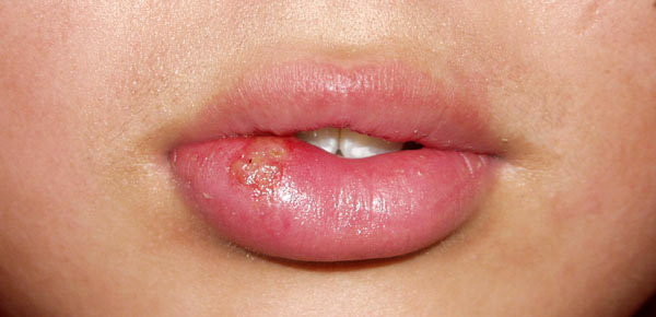 口唇ヘルペス 症状